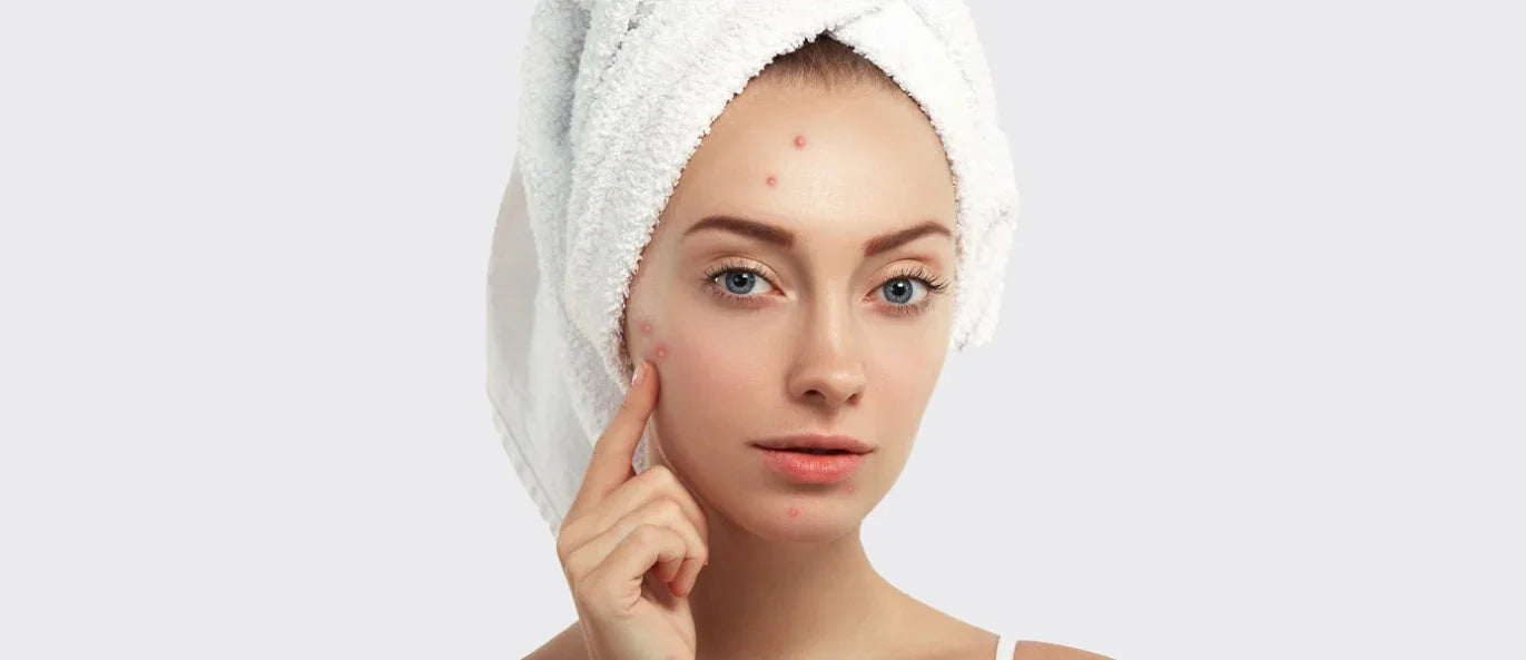 Woman with towel on head, clear skin, and minimal acne, skincare treatment result